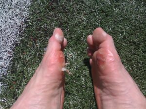 soccer blisters